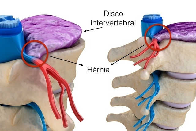 Hérnia de Disco: o que é, causas e revisão anatômica - Sanar Medicina